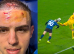 Nikola Krstović, do Atalanta, mostra a testa ap&oacute;s um p&ecirc;nalti dram&aacute;tico nos &uacute;ltimos minutos contra o BVB