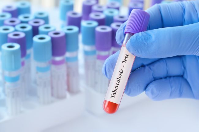 Kansas enfrenta o maior surto de tuberculose da história dos EUA