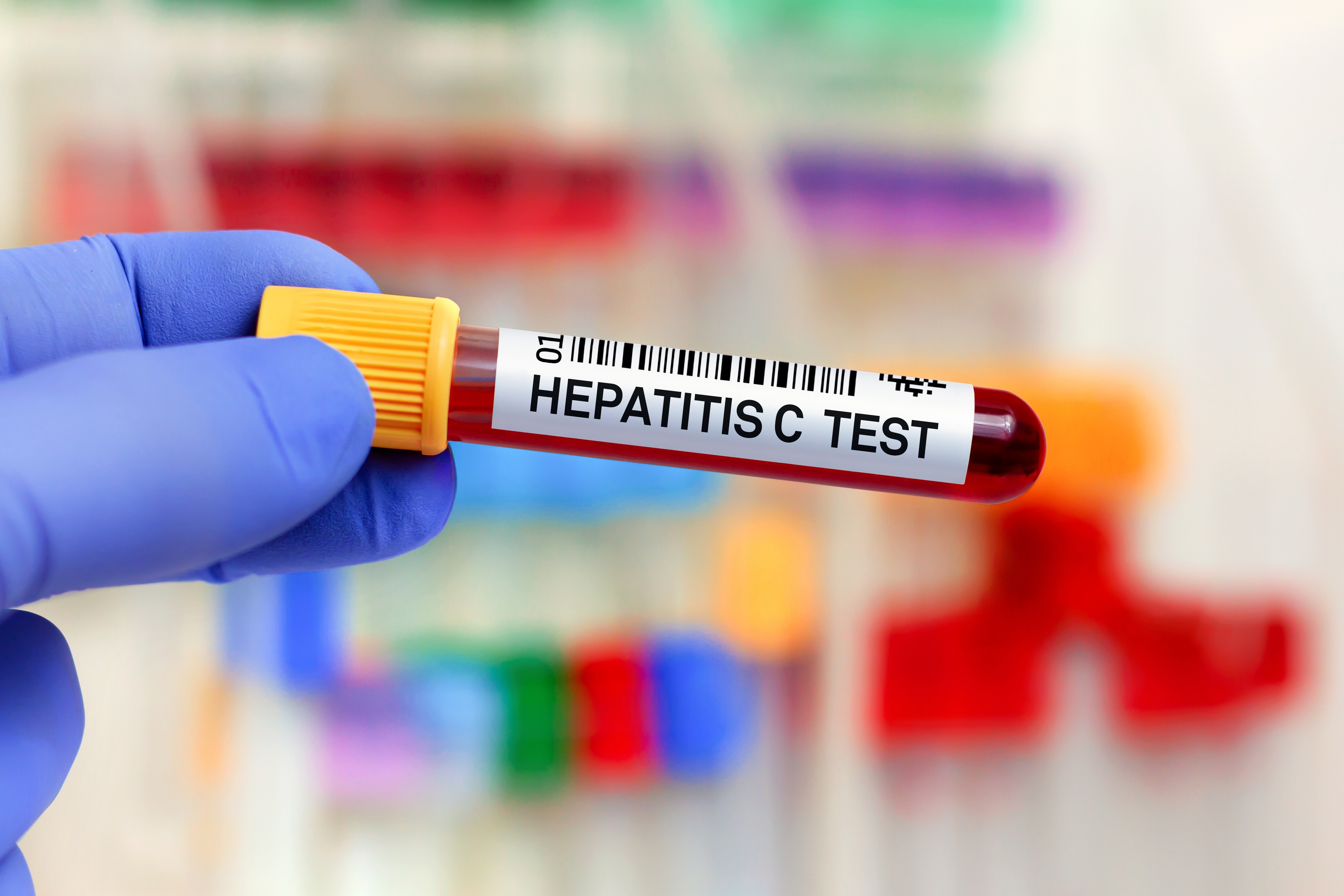 Inglaterra no caminho para se tornar um dos primeiros países a eliminar a hepatite C